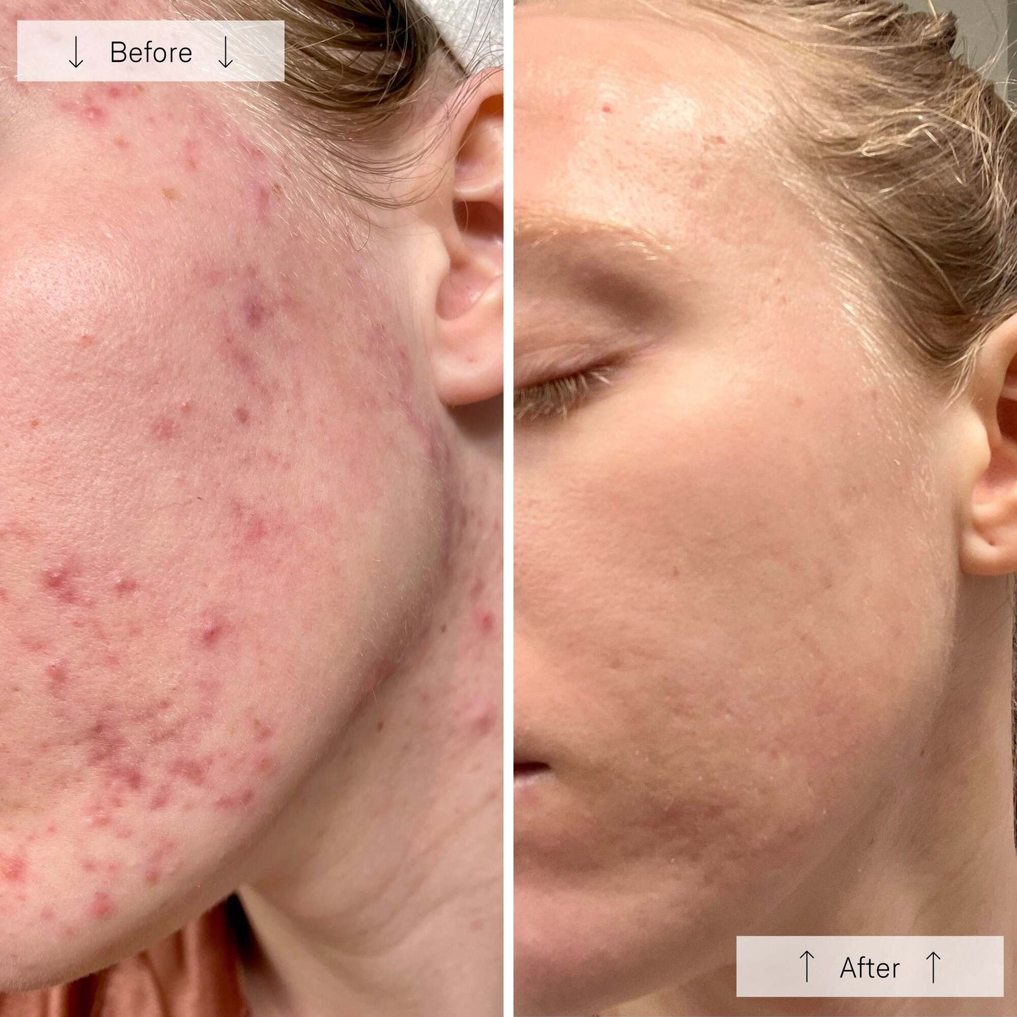 Omnilux LED Face Mask - CLEAR