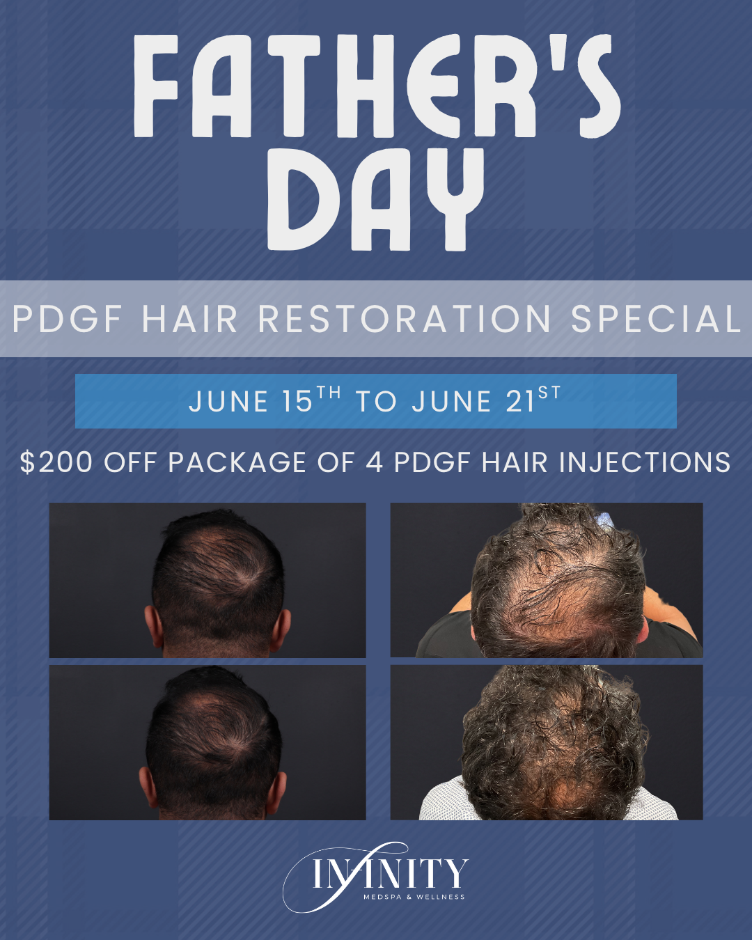 PDGF Hair Restoration - Fathers Day 2026