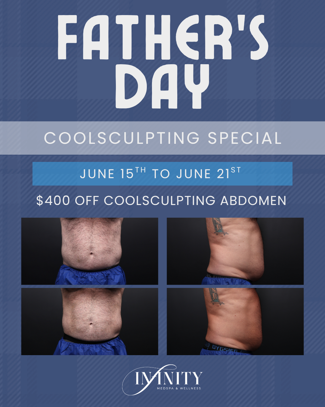 Fathers Day CoolSculpting Special 2026