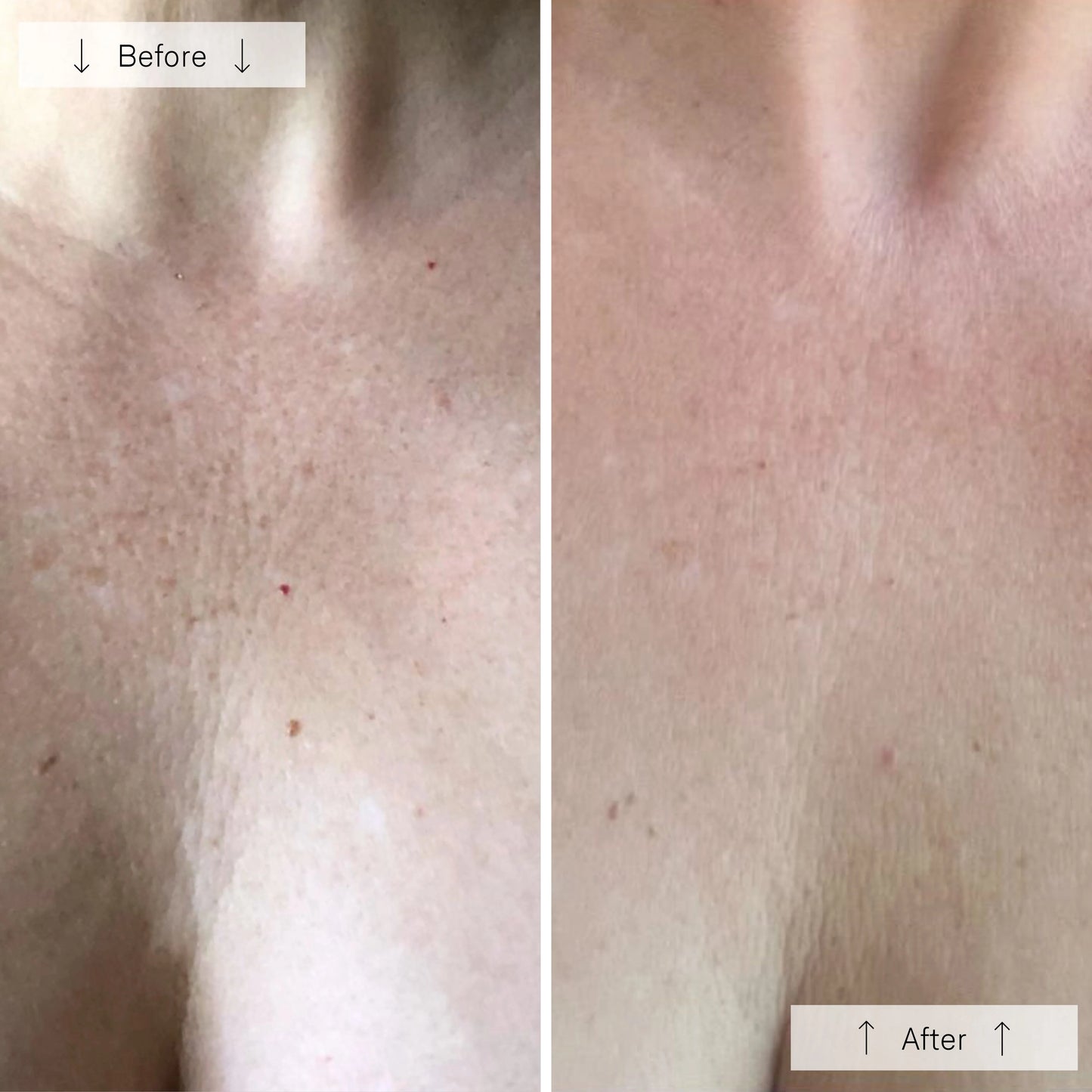 Omnilux LED Mask - Neck & Décolleté
